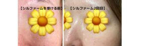 シルファームの効果はいつから？